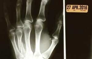 TNA Knockout Has A Broken Hand