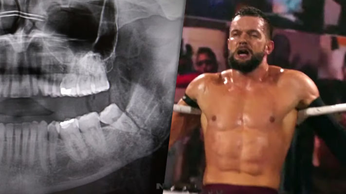 Finn Balor Undergoes Successful Surgery