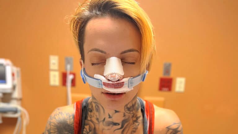 Ruby Soho Recovering from Surgery to Correct a Broken Nose