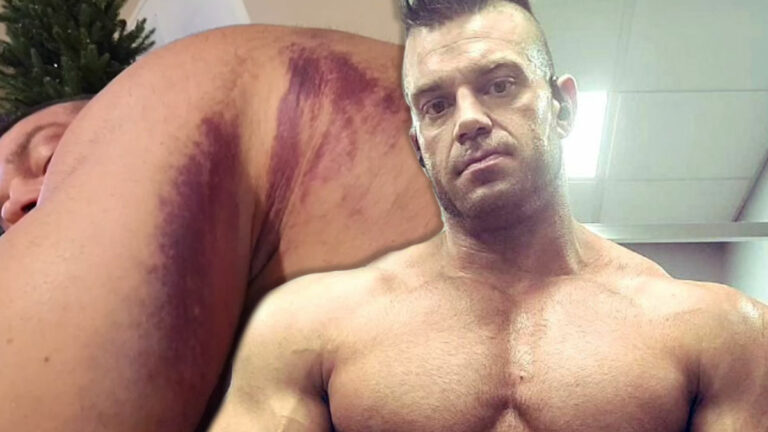 Brian Cage Shows Off Insane Bruising After Rough Spot On AEW Dynamite