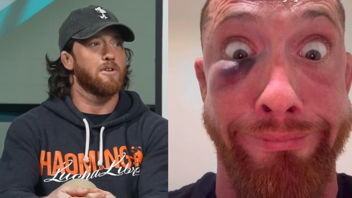 Kyle O’Reilly showing a swollen black eye after AEW Dynamite in Glasgow